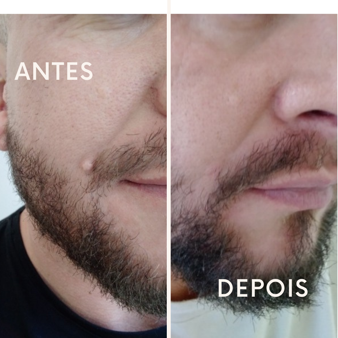 Resultado Remoção de Fibromas